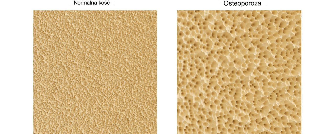 Normalna struktura gęstości kostnej i z osteoporozą