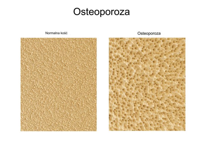 Normalna struktura gęstości kostnej i z osteoporozą