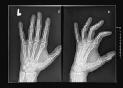 obraz rentgenowski dłoni lewej - drętwienie palców