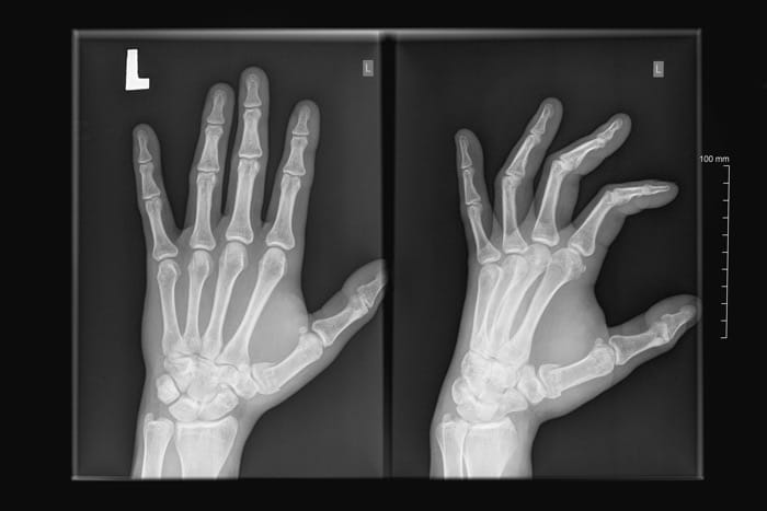 obraz rentgenowski dłoni lewej - drętwienie palców